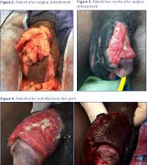 Fournier's gangrene is an aggressive synergistic fasciitis of the perineum. Pdf Fournier S Gangrene Of The Penis In A 12 Year Old Patient Secondary To Phimosis Semantic Scholar