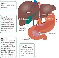 Liver cancer can be difficult to diagnose because symptoms are often vague and sometimes they only appear at an advanced stage. Liver Tumors Cancer Facts Seattle Cancer Care Alliance