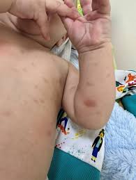 Image result for Urticaria pigmentosa children