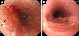 „ histology shows koilocytosis (atypical ringed nucleus), giant cells. The Clinical Characteristics And Manifestations Of Cytomegalovirus Esophagitis Semantic Scholar
