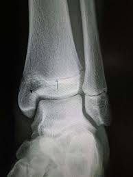 A foot bone that sits above the heel bone (talus). The Tibia Proximal Shaft Distal Teachmeanatomy