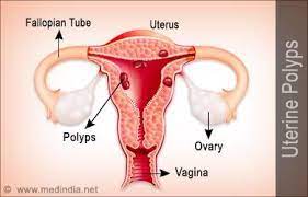 Uterine Polyps Endometrial Polyps Uterine Polyps Polyps Uterus Polyp
