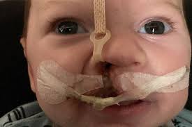 Fundraiser for Alyssa Macomber by Kristina Caschetta : Austin's Road to  Cleft Recovery