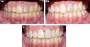 Image result for Tooth Discoloration