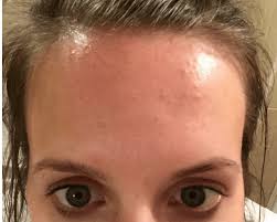 How I Cleared My Tiny Bumps On Forehead Once For All Forehead Bumps Skin Bumps On Face Forehead Acne Cause