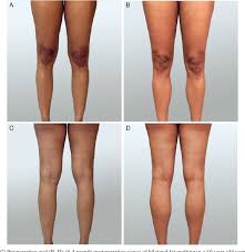 Figure 6 From Calf Augmentation And Reshaping With Autologous Fat Grafting Semantic Scholar