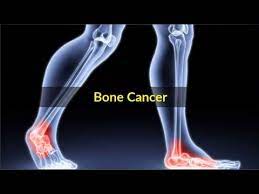 Primary bone cancer is very rare. Bone Cancer Symptoms Pictures Causes And Symptoms Of Bone Cancer In Men Women Youtube