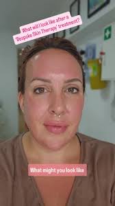 What will you look like after a Bespoke Skin Therapy treatment??, I had a  BioRePeel, micro-needling, and skin boosters combo, and here I am, straight  after 💁‍♀️