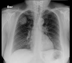 Eifel p, klopp ah, berek js, and konstantinopoulos a. Lung Cancer With Cervical Metastases Radiology Case Radiopaedia Org