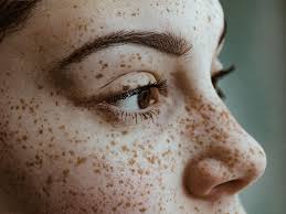 Eating a food or medicine you're allergic to can cause you to break out in hives (also called urticaria), an itchy red rash. How To Prevent And Treat Pimples After A Wax