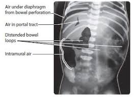 Image result for Necrotizing Enterocolitis