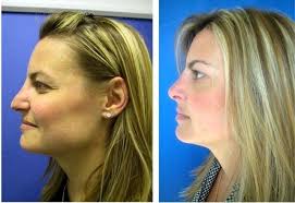 Plastic Surgery Nose Job What A Difference Facial Plastic Surgery Facial Plastic Rhinoplasty