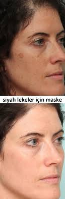 Yuzdeki Siyah Lekeler Icin Dogal Tarifler Natural Acne Skin Care Dark Spots On Face Spots On Face