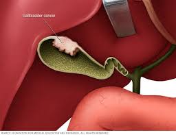 The symptoms of liver failure often look like symptoms of other medical conditions, which can make it hard to diagnose in its early stages. Gallbladder Cancer Symptoms And Causes Mayo Clinic