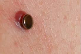 How To Get Rid Of A Piercing Bump Piercing Bump Nose Piercing Jewelry Nose Piercing Healing