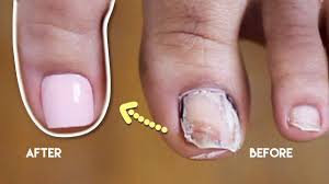 Acrylic nails are the hottest trend and the easiest way to add length and glam to your nails. Broken Toenail Transformation At Home Diy Toe Nail Extension For Beginners Using Madam Glam Youtube