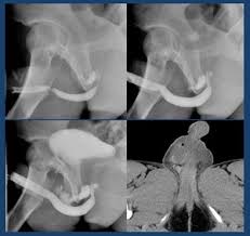 Image result for Retrograde Urethrogram