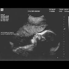Das baby hat überlebenschancen bei einer frühgeburt. 31 Ssw Schwangerschaftswoche Alle Infos Grosse Entwicklung
