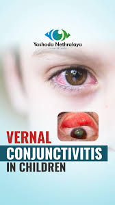 Image result for Vernal Conjunctivitis