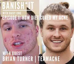 Brian Turner Explains How Diet Cured His Acne