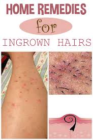 This is a popular treatment for acne and it will help you. 47 Ingrown Hairs Ideas Ingrown Hair Ingrown Hair Remedies Ingrown Hair Removal