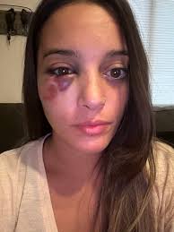 Horse riding injury to orbital and leg