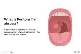 Image result for Peritonsillar Abscess