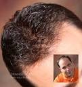 Men's Hair Loss Solutions - Fort Lauderdale, Florida