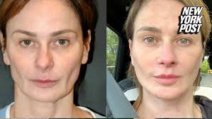 I got surgery to fix my ‘resting bitch face’ — and I’m so happy with the  results