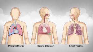 Treatment options may include observation, needle aspiration, chest tube insertion, nonsurgical repair or surgery. Medsim Respiratory System Palpation Youtube