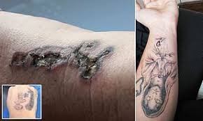 Watch this man have his face tattoo removed from laser surgery. Customers Share Their Horrifying After Images As Their Skin Is Left Blistered And Burning Daily Mail Online