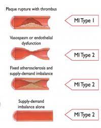 Check spelling or type a new query. Non St Elevation Myocardial Infarction Wikem