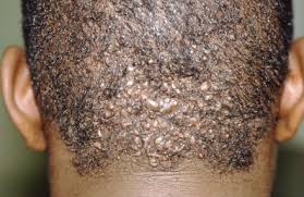 They can cause small round, and often itchy or painful, bumps. Ingrown Hair Januari 2021