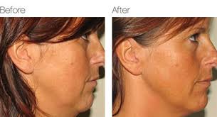 The fade haircut has typically been satisfied men with short hair, yet lately, men have been. Face Jowls Sagging Jaw Non Surgical Solutions At Radiant Living