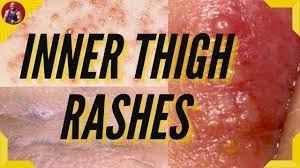 Rashes Between Legs Causes Treatment How To Treat Inner Thigh Rash Youtube