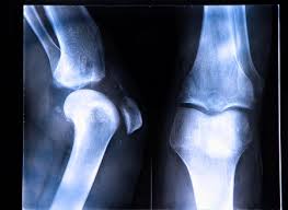 Many times, a popping noise can be heard at the. Acl Tear Treatment Of Injured Acl At No Fault Doctor In Forest Hills Ny