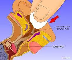 How To Get Rid Of Earwax Ear Cleaning Wax Clean Ear Wax Out Ear Wax Buildup