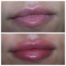 How long does it take for juvederm to settle in lips. Juvederm Ultra Plus Radiance Medspa Hartford Ct Avon Ct