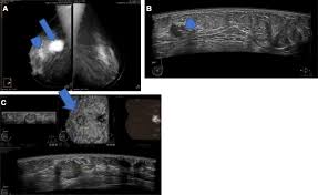 There may be guidelines to limit the maximum to under 4 weeks. Automated Breast Ultrasound System Abus Can It Replace Mammography As A Screening Tool Egyptian Journal Of Radiology And Nuclear Medicine Full Text