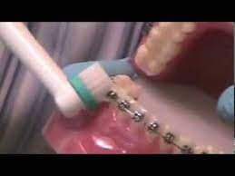 Know how you brush your teeth. Brushing Braces With An Electrictoothbrush Youtube