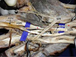 Repair of the damaged tendons is necessary to restore normal movement in the thumb and hand. Multiple Tendons Of The Additional Belly Of Flexor Pollicis Longus In The Carpal Tunnel Embryological Perspective And Their Clinical Significance