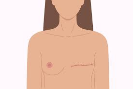 Image result for Mastectomy