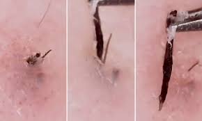 On one end, they resemble a pimple with a raised pore and whitish bump on top. Ingrown Hair Account Tweezist Is Your New Guilty Pleasure Daily Mail Online