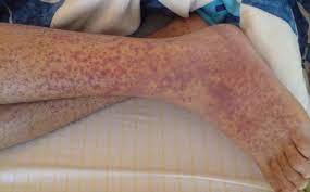 Purpura is the result of hemorrhage into the skin or mucosal membrane. Palpable Purpura On Lower Legs Which Occurred 4 D After The Surgery Download Scientific Diagram