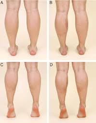 Messages from the nervous system cause these muscle contractions. A C A 26 Year Old Woman Complaining Of Prominent Calves With Plantar Download Scientific Diagram