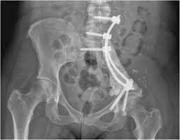 Along with these symptoms, basic side effects occur from pelvic bone cancer as well. Pelvic Ewing Sarcoma A Retrospective Outcome Analysis Of 104 Patients Who Underwent Pelvic Tumor Resection At A Single Supra Regional Center Journal Of Orthopaedic Surgery And Research Full Text