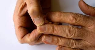 Swollen Finger Swelling Fingers Symptoms Causes Treatments Diagnosis