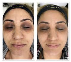 ILBEYS LEKE PROTOKOLÜ 🤌🏻🤌🏻🤌🏻 2.seans #leketedavisi #lekeprotokolü