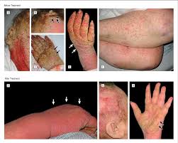 Image result for scabies norvegica