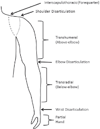 4 Upper Extremity Prostheses The Promise Of Assistive Technology To Enhance Activity And Work Participation The National Academies Press